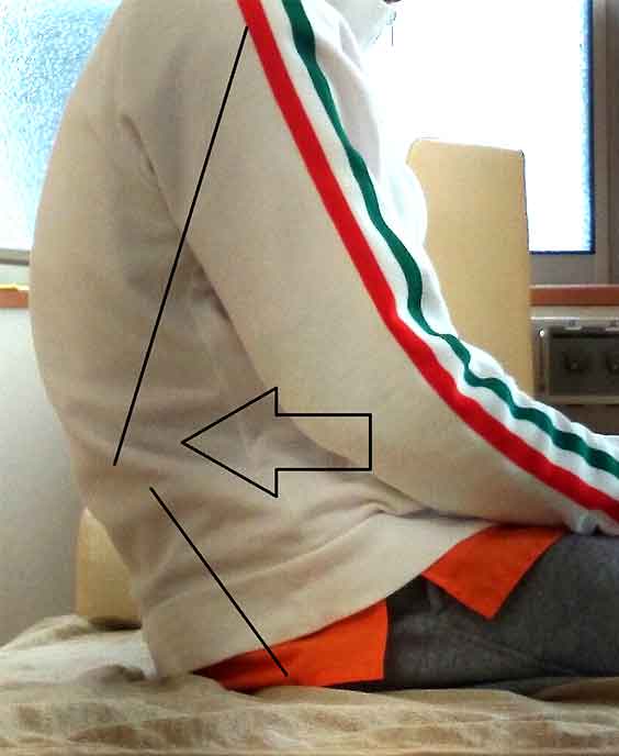 側わん症のイメージ2