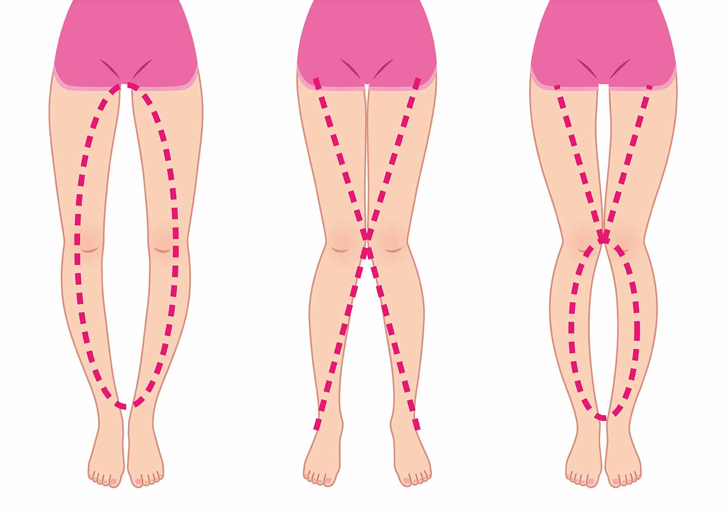 X脚・O脚のイメージ